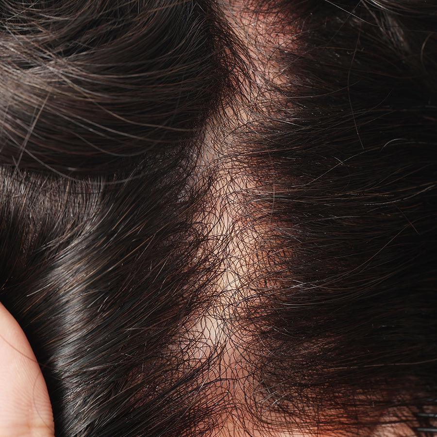 MSSV | Sistema de cabello invisible de 0.02 mm de grosor con bucle en V para hombres